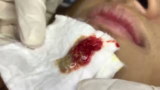 Extreme Satisfying Blackhead Removal 138  Acne Treatment [upl. by Rollo]