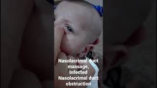 Nasolacrimal duct massageinfected Nasolacrimal duct obstruction Dr Hunar Jamal [upl. by Annodahs]