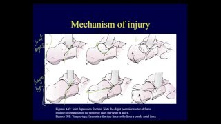 Calcaneal fractures  Anatomy evaluation classification OTA lecture series IV L15a [upl. by Yraunaj776]