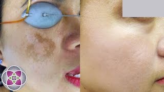 Laser Melasma amp Hyperpigmentation Treatment [upl. by Kieryt486]