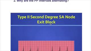 Sick Sinus Syndrome [upl. by Walden]