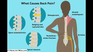 Back Pain I Lower back pain Pain or ache in the lower region of the back varying in intensity [upl. by Ert]