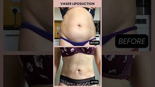 Vaser Liposuction Before and After Transformation  vaserlipo  Manchester Private Hospital [upl. by Medardas97]