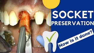 Tooth extraction and SOCKET PRESERVATION  How is it done [upl. by Evelyn]