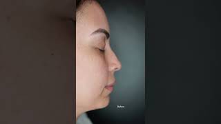 Non surgical nosejob with Fillers [upl. by Hepza478]