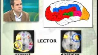 Dislexia 2ª parte entrevista en Etb2 [upl. by Aselehc]