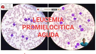 PROMIELOCITOS PATOLÓGICOS LEUCEMIA PROMIELOCÍTICA AGUDA MORFOLOGÍA [upl. by Niac892]