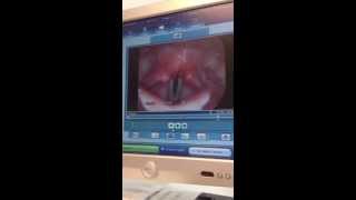 Alexs Laryngoscopy Amazing [upl. by Refynnej]