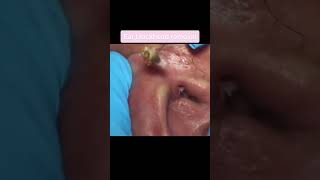 Ear Blackhead Removal oddlysatisfying sick blackhead pimplepopper satisfying cyst omg lol [upl. by Eseila]