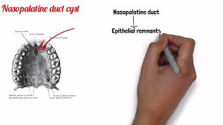 FISSURAL CYSTS  ORAL PATHOLOGY [upl. by Ygiaf]