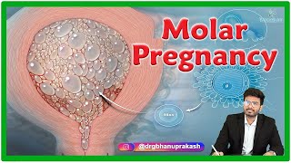 Molar Pregnancy  Causes Clinical manifestations Diagnosis and Treatment [upl. by Sigismondo]