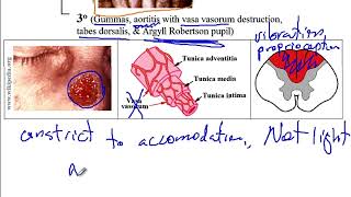 USMLE ACE Video 91 Genital Ulcers [upl. by Azalea]