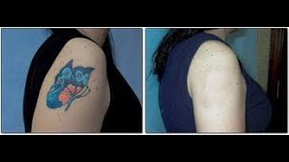 Tattoo Removal With Salt  Heroic But Cheap [upl. by Mitch]