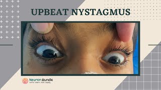 nystagmus  eye movements l demo on a patient l horizontal amp vertical nystagmus neurology [upl. by Lemart]