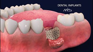 How to Perform Dental Implants by MIS Tutorial 3D Dental Animation [upl. by Ydnamron]