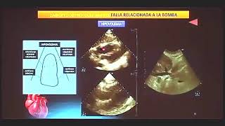 ECOCARDIOGRAFIA EN LOS DISTINTOS TIPOS DE SHOCK [upl. by Branham900]