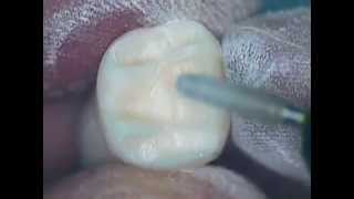 Crown Preparation Tooth Number 30 Part 1 [upl. by Rengaw702]