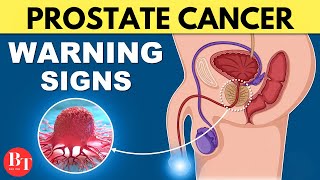 Prostate Cancer Symptoms Warning Signs Of Prostate Cancer [upl. by Potash270]