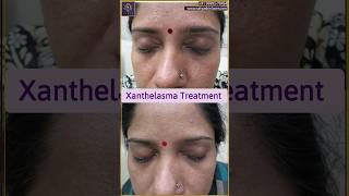 Xanthelasma removal treatment  Xanthelasma treatment laser  youtubeshort shorts xanthelasma [upl. by Mcgrody]