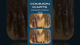 Common Warts Everything You Need to Know [upl. by Osy]