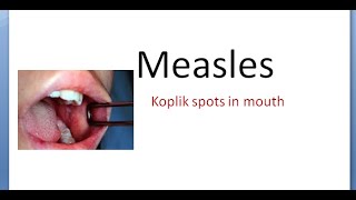 PSM 156 Measles Natural History Koplik spot differential rash diagnosis Rubeola powder SSPE vaccine [upl. by Faye481]