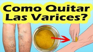 REMEDIOS CASEROS PARA LAS VARICES Como Quitar Las Varices Con Tratamientos Naturales [upl. by Xineohp707]