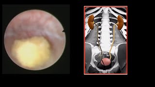 How to remove a kidney stone Live Patient Video [upl. by Esiuole239]