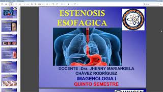 Estenosis Esofagica Varices Esofagicas y GástricasAcalasiaSíndrome de Malory Weis [upl. by Eetsirk]