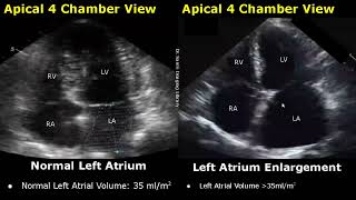 Echocardiography Normal Vs Abnormal Images  Heart Ultrasound  Cardiac ColorSpectral Doppler USG [upl. by Wallie]