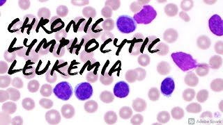 Chronic Lymphocytic Leukemia CLL Peripheral Blood Smear Hemepath Hematology Pathology [upl. by Nybbor728]