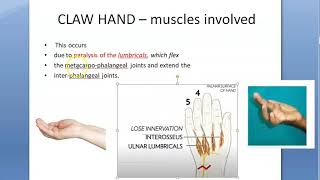 Orthopedics 083 claw hand ulnar nerve palsy type treatment ape simian lumbrical paradoxical Zancolli [upl. by Nohsreg135]