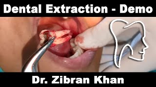 Dental Extraction  Clinical Demonstration [upl. by Fransisco520]