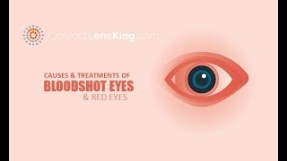 Bloodshot Eyes Red Eyes Causes and Treatments [upl. by Annodahs]