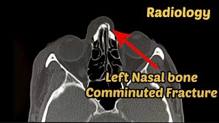 Facial Bone  Fracture  Ct scan  Radiology [upl. by Grubb]