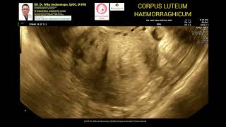 Corpus Luteum Haemorrhagicum [upl. by Nautna]