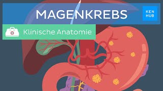 Magenkrebs Ursachen Symptome Diagnose Prognose  Kenhub [upl. by Dustan643]