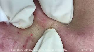 Big Cystic Acne Blackheads Extraction Blackheads amp Milia Whiteheads Removal Pimple Popping [upl. by Salbu]