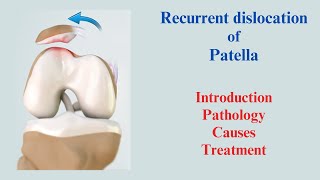 Recurrent dislocation of Patella Introduction Pathology Causes amp Treatment [upl. by Ysdnyl]