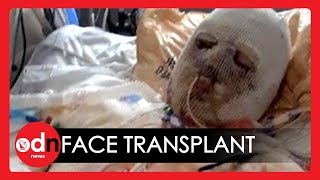 Worlds First Face and Hand Transplant Surgery Hailed a Success [upl. by Elem]