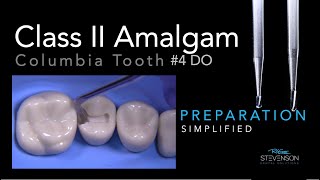 Amalgam Simplified Preparation  Columbia 4 DO  Two Burs Only [upl. by Audy34]