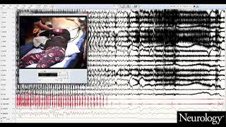 Postconvulsive central apnea as a biomarker for sudden unexpected death in epilepsy SUDEP 2 [upl. by Dumanian]