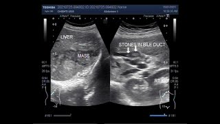 Distended Gallbladder with Cholelithiasis associated with Choledocholithiasis and Hepatic Mass [upl. by Llehcim]