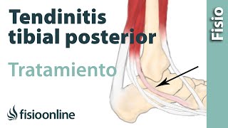 Tendinitis del tibial posterior Tratamiento con ejercicios de fisioterapia [upl. by Aip]