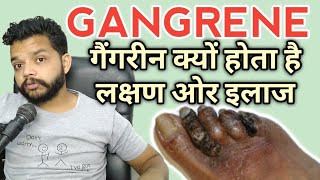 गँगरीन को बिना ऑपरेशन कैसे ठीक करे part 1  How to Cure Gangerene without SurgeryPart 1 [upl. by Twila327]