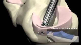 Arthroscopic Meniscus Repair [upl. by Tutto]