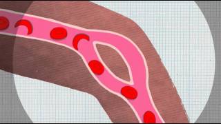 Sickle Cell Anaemia Explained [upl. by Aerdnaeel735]