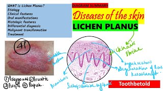 Oral Lichen planus Part 2  Oral manifestations  Histopathology Diagnosis amp Treatment [upl. by Lombardo528]