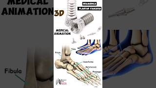 Gramedica Plantar Fasciitis medical 3danimation short biology With Aliya [upl. by Tol]