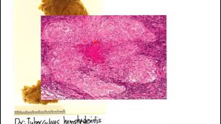 Lymphadenopathy TB vs Lymphoma [upl. by Nej]