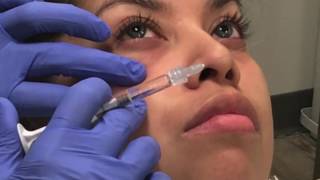 Belotero Injections to Correct the Tear Trough Hollow [upl. by Casimir]